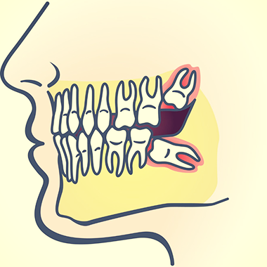 Wisdom Teeth