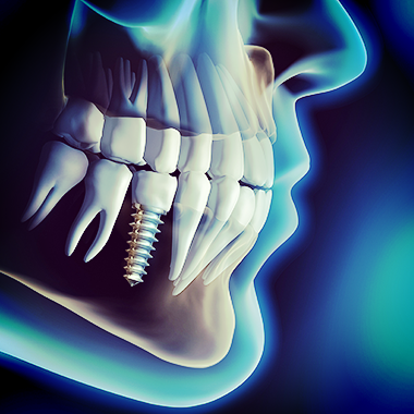 Dental Implants